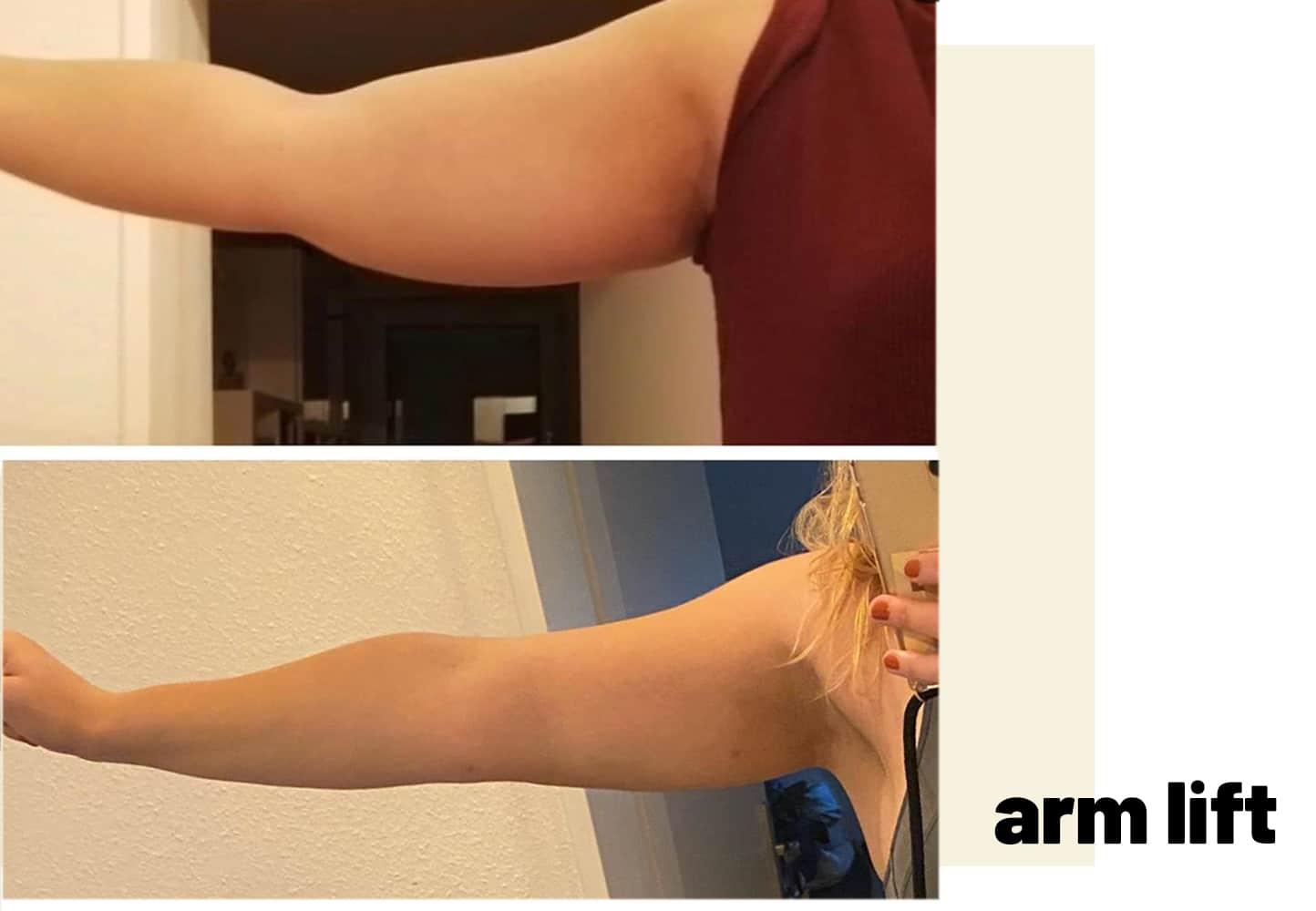 arm lift turkey before and after