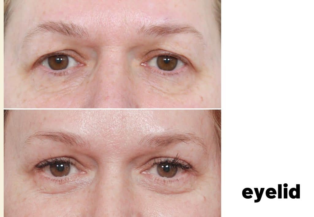 eyelid before and after