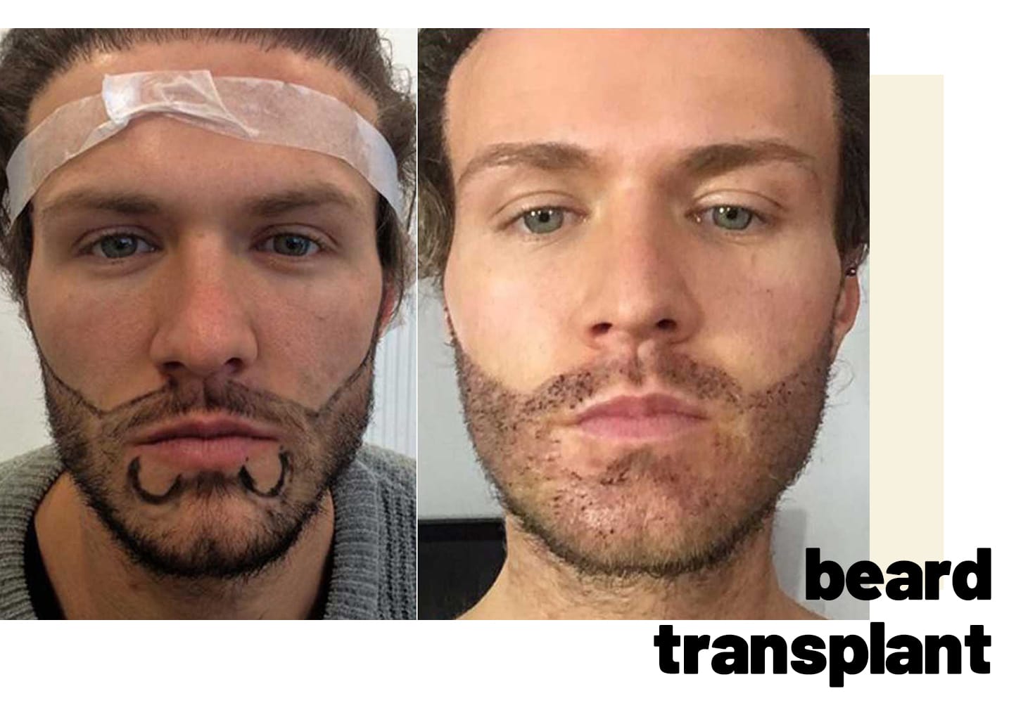 facial hair transplant turkey before and after