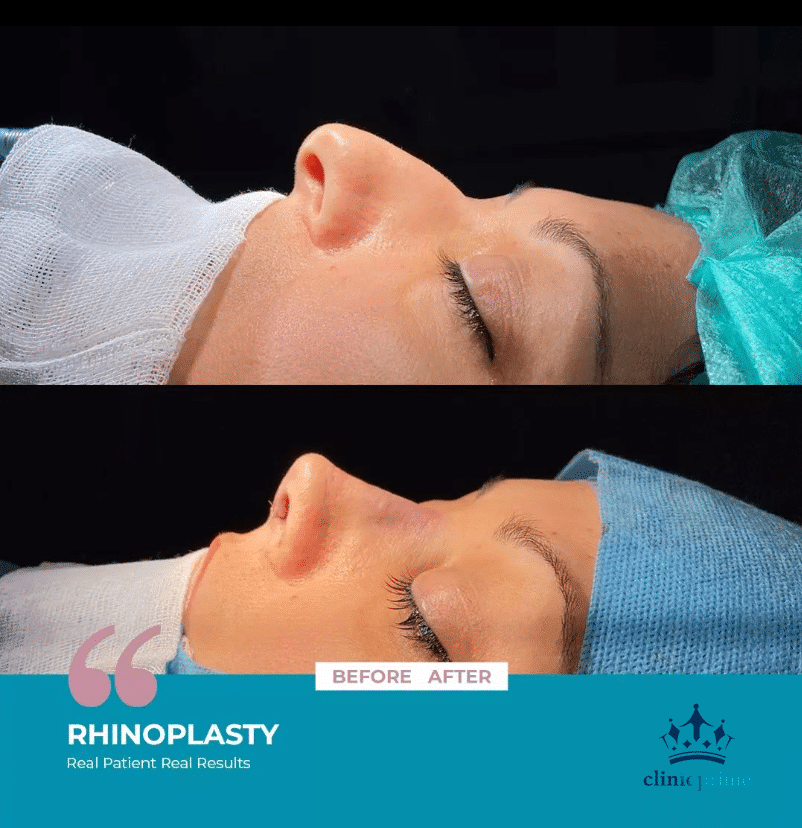rhinoplasty turkey before and after